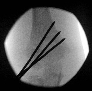 Supracondylar Lateral K wires